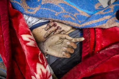 Lancet: Gazze'de can kaybı bildirilenden çok daha yüksek