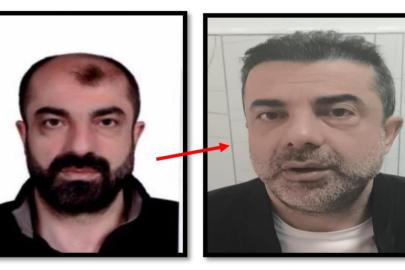 Estetikle yüzünü değiştiren cinayet zanlısı yakalandı
