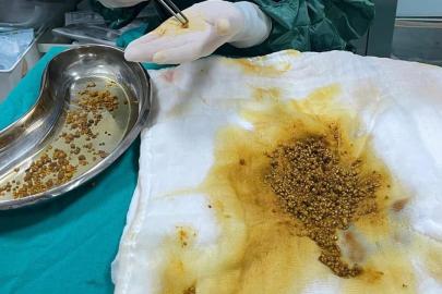 Hastanın ameliyatında 2 bin 67 taş çıkarıldı